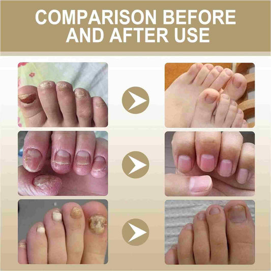 Zidella Herbal Nail Nourishing Essence ? 30ml (Pack of 2)