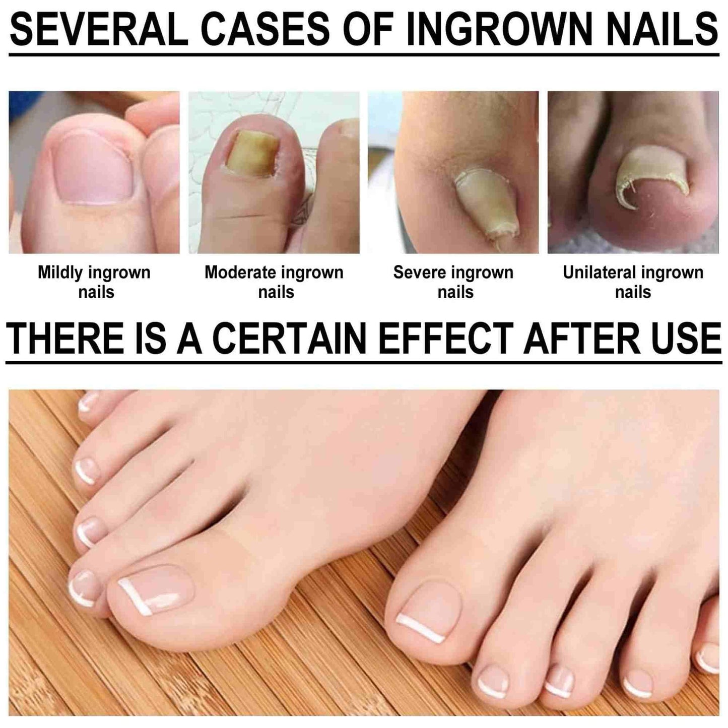 Zidella Ingrown Toenail Drops ? Soften Nail & Pain Reliever (30ml) (Pack of 2)