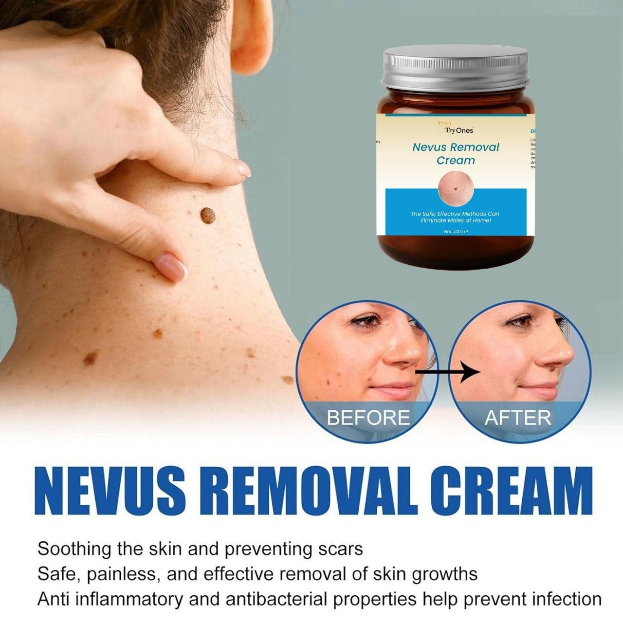 Nevus Removal Cream 200 ml Pack of 2