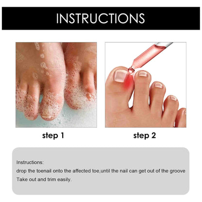 Zidella Ingrown Toenail Drops ? Soften Nail & Pain Reliever (30ml) (Pack of 2)